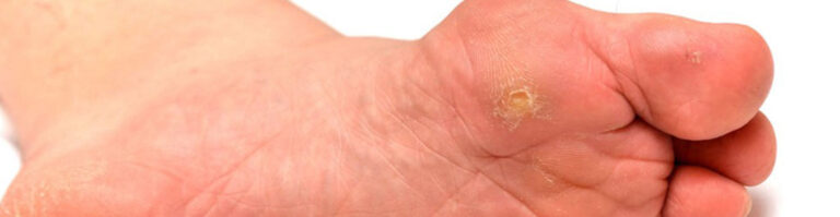 corns treatment