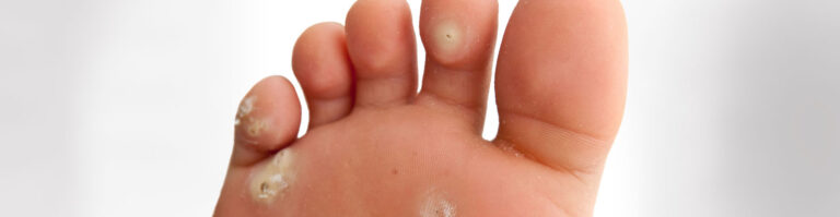 verrucae treatment