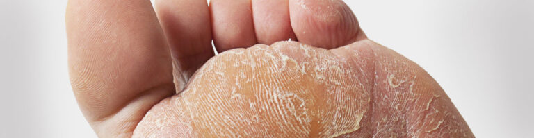 callus treatment