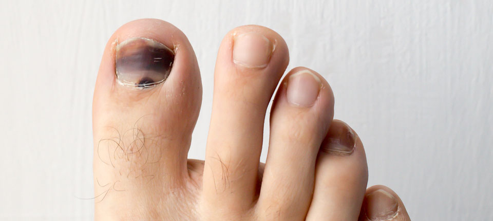 Listen up Walkers and Runners – 'Black Toenails' are Preventable! -  Footfriend